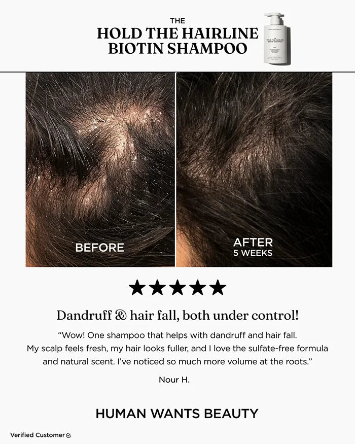 The Hold The Hairline Biotin Shampoo before and after testimonial showing dandruff and hair fall under control