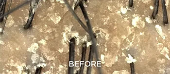 Dandruff Relief at a Cost