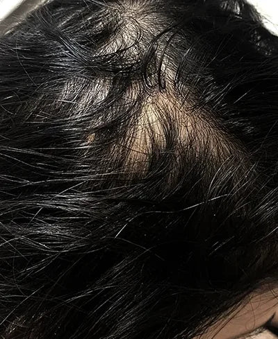 Hair fall and dormant roots concern