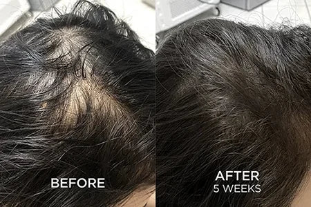 HWB Hair fall and hair growth before and after results