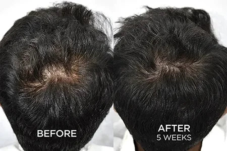 HWB Hair fall and hair growth before and after results