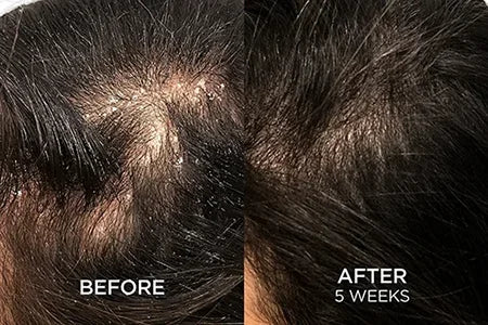 HWB Hair fall and hair growth before and after results