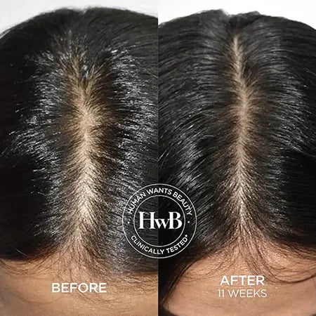 THE HWB SCALP SUPREME SET