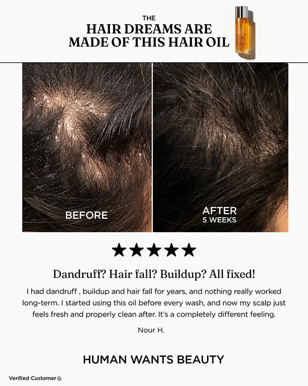 The Hair Dreams Are Made Of This Hair Oil before and after testimonial for dandruff and hair fall