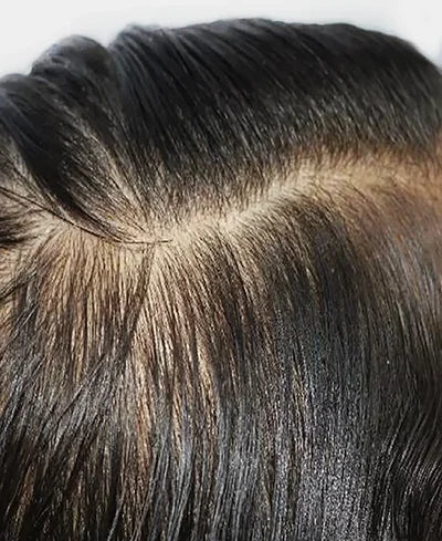 Excess sebum and oily scalp concern