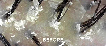 Surface Cleanse, Neglected Scalp